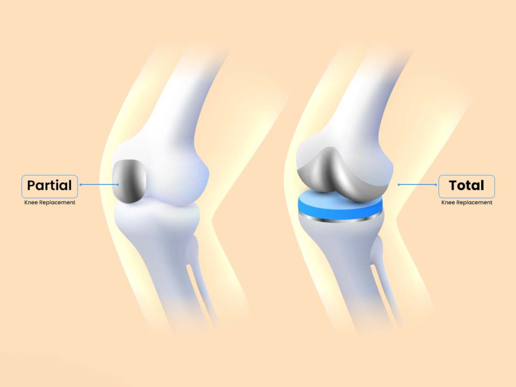 Knee Replacement Surgeon in Malad