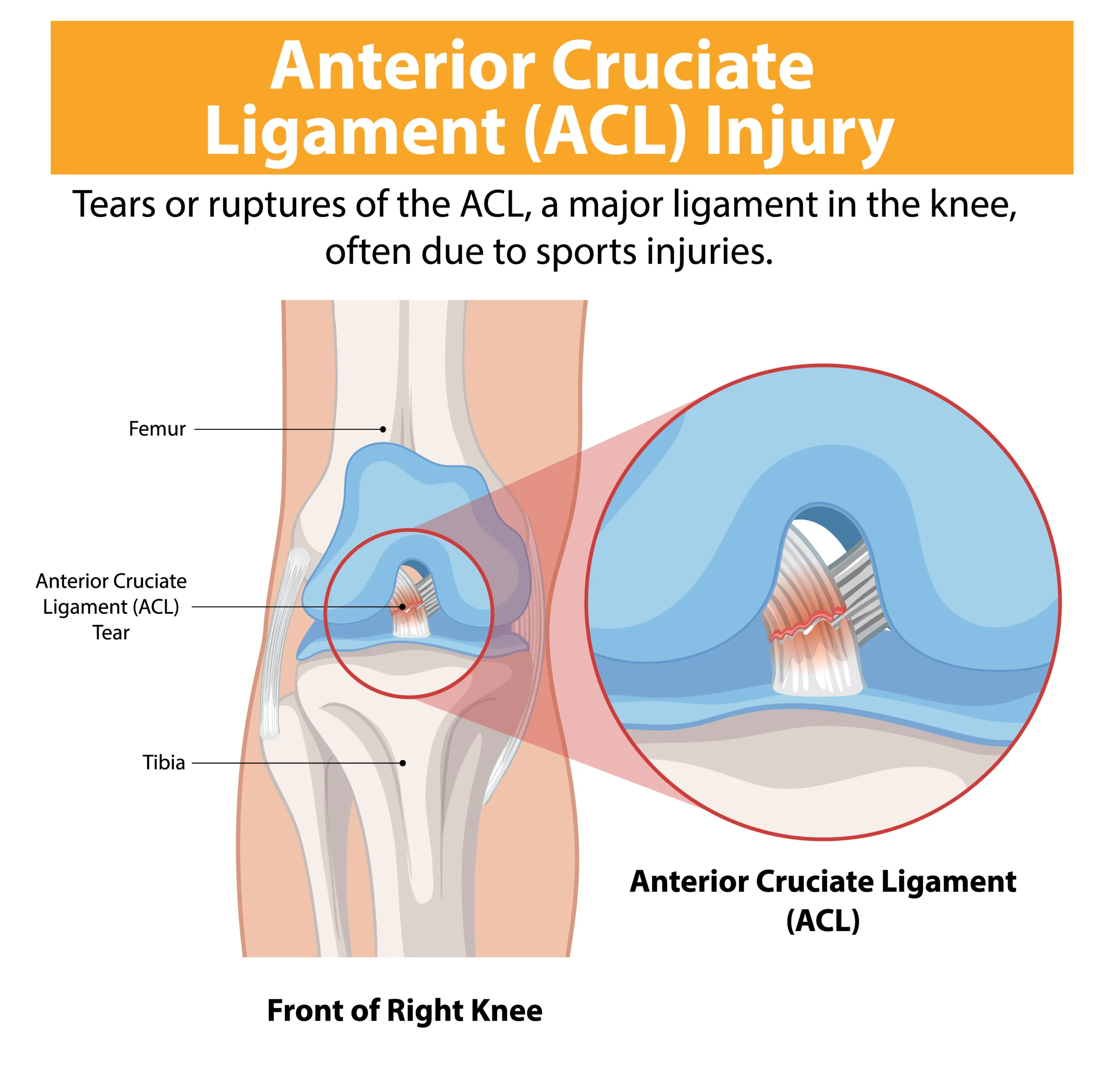 ACL injury