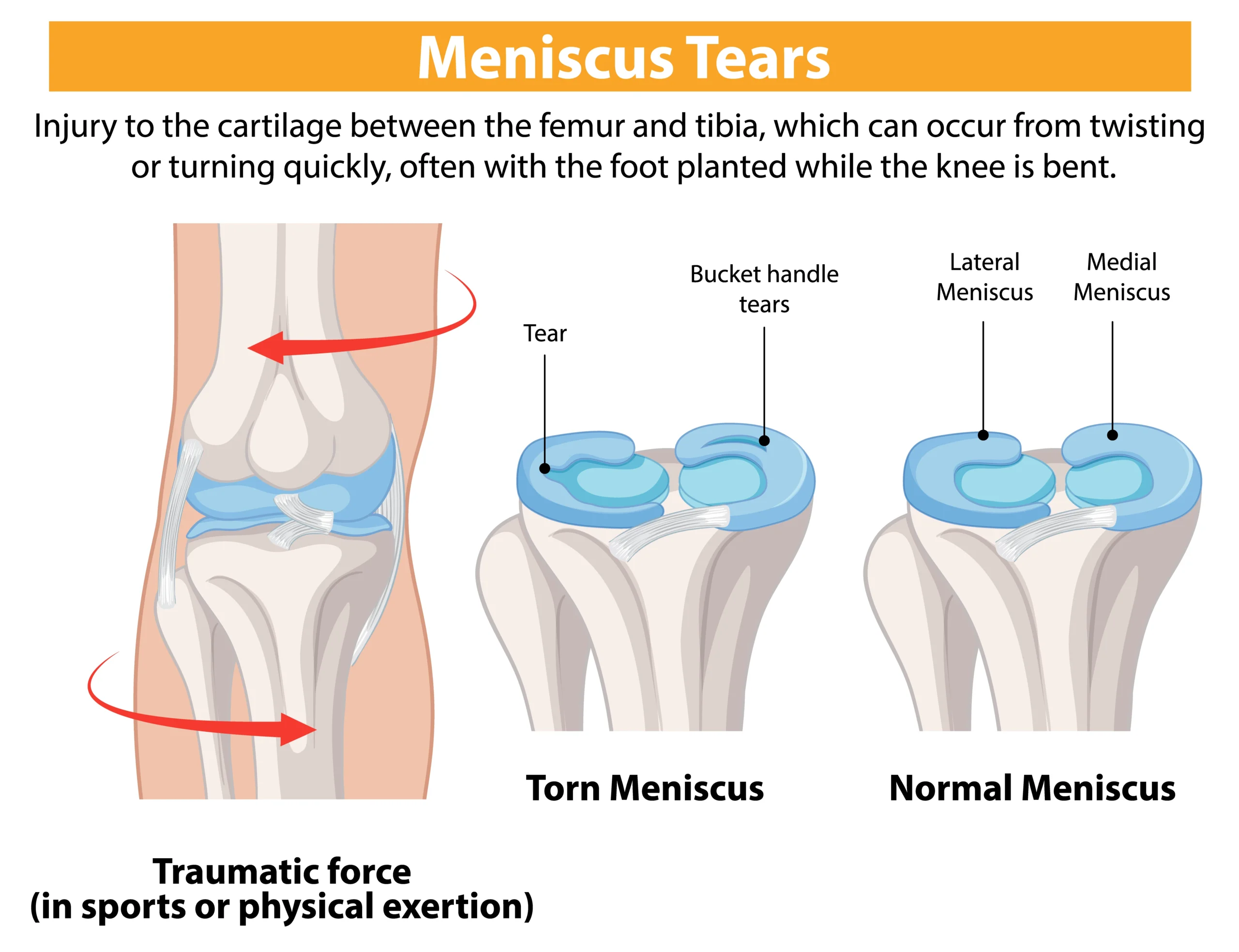 Meniscus Tear