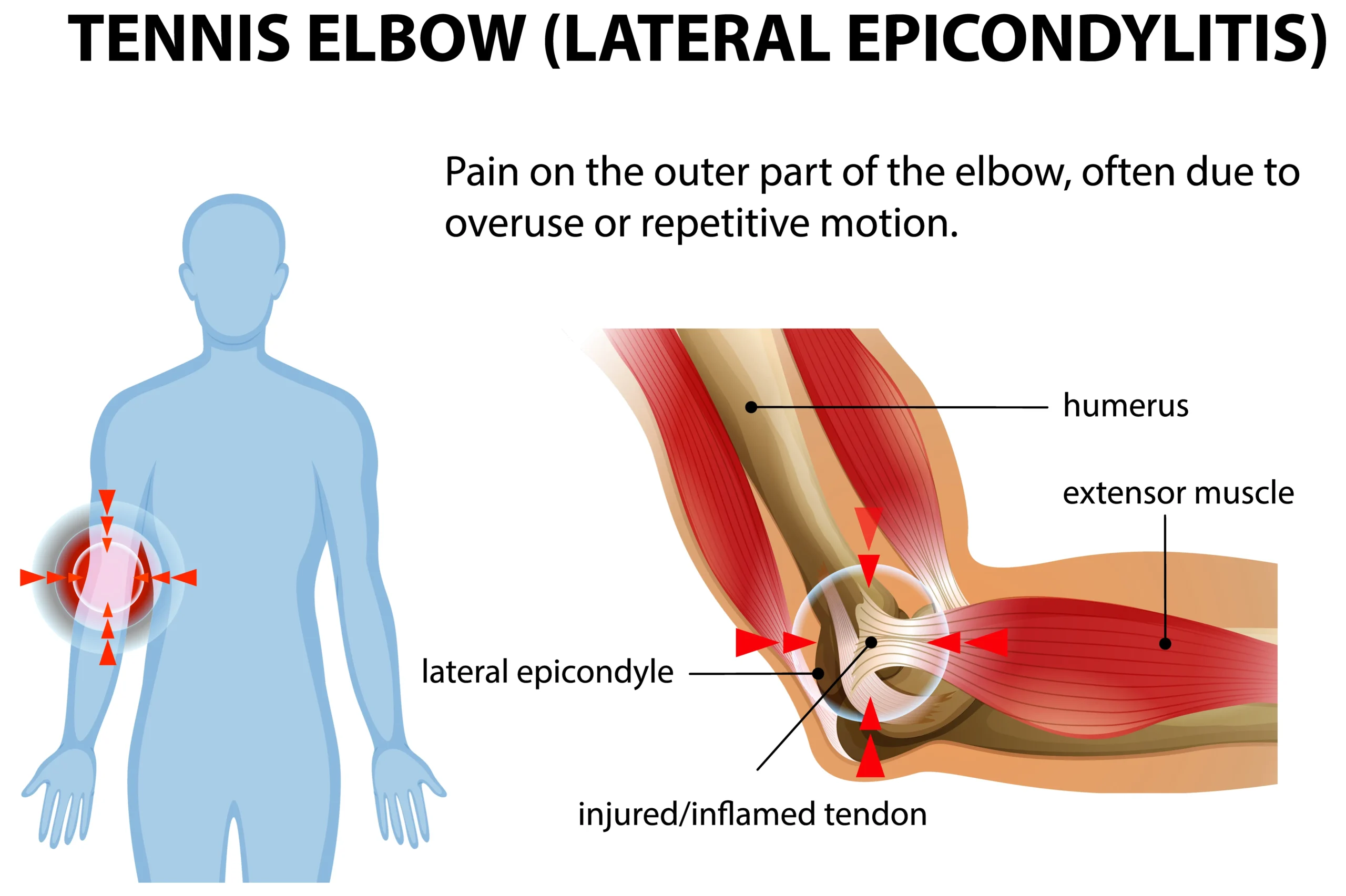 Tennis Elbow