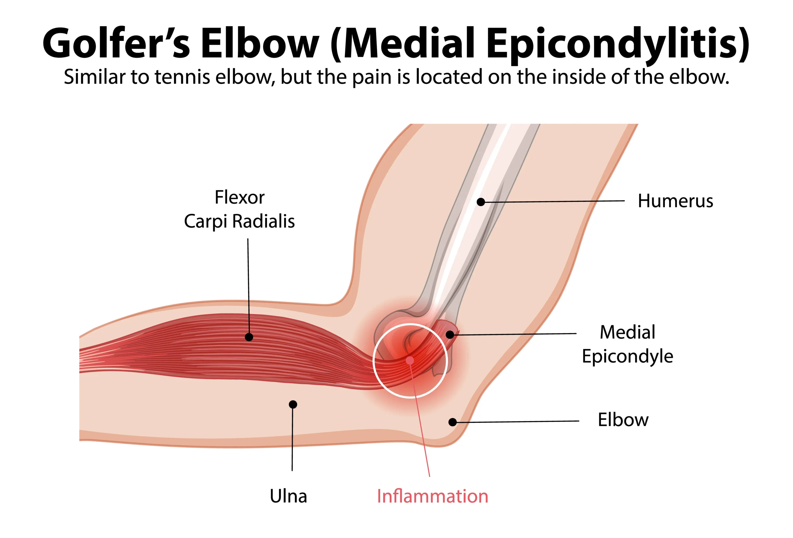 Golfer's Elbow vs Tennis Elbow